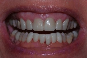A picture of client's mouth after implants