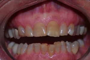 A picture of client's mouth before implants