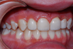 A picture of client's mouth after implants